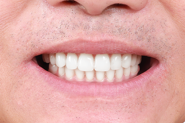 Những điều cần biết về cấy ghép Implant Tuổi thọ lâu, bền chắc, chức năng ăn nhai tốt