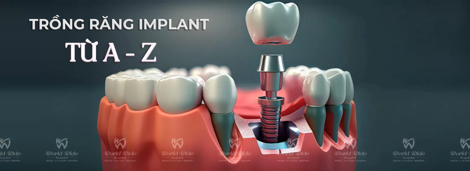 Những điều cần biết về cấy ghép Implant