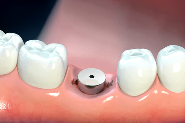 Những điều cần biết về cấy ghép Implant implant