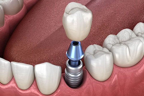 Những điều cần biết về cấy ghép Implant