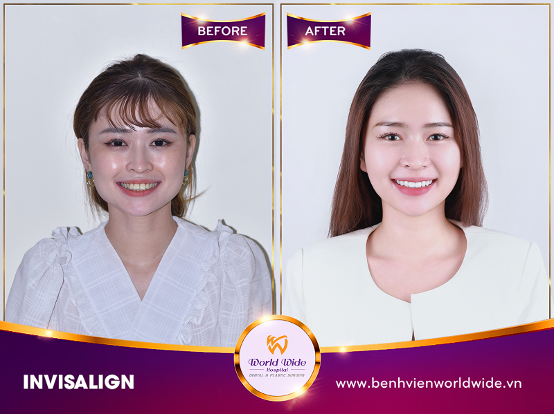 niềng răng mắc cài