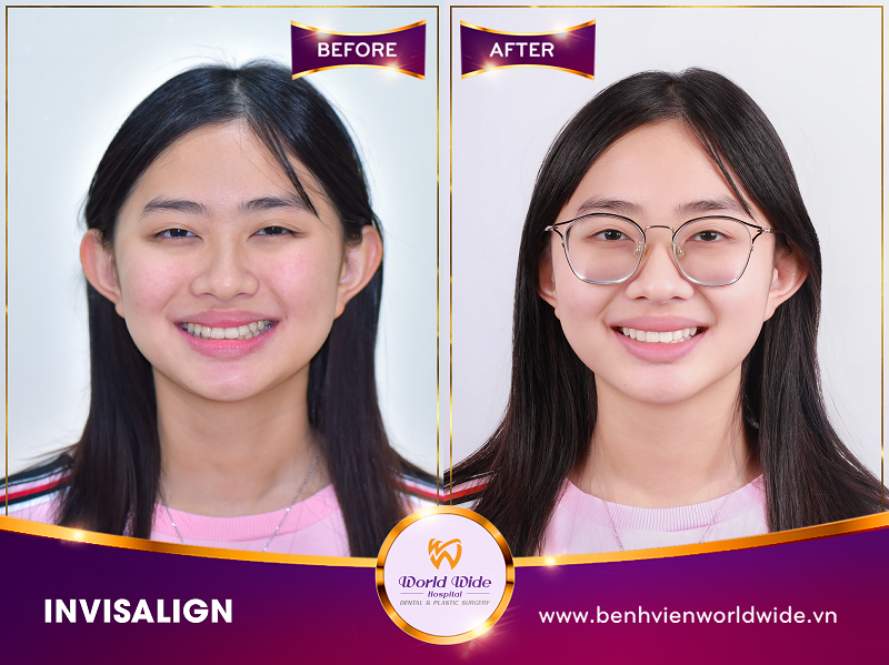 invisalign Kỳ Duyên