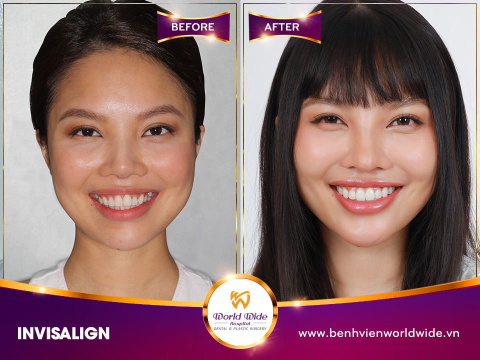 niềng răng mắc cài