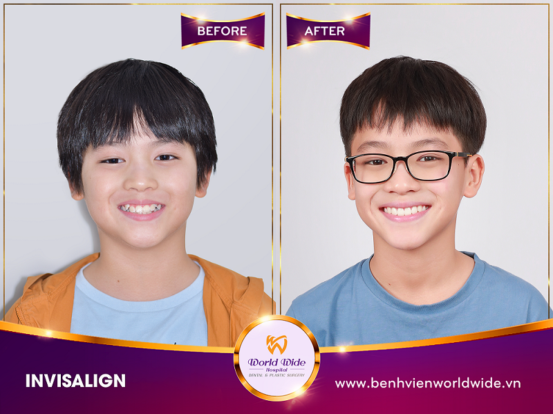 niềng răng mắc cài