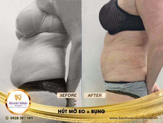 HÚT MỠ SIÊU ÂM vóc dáng