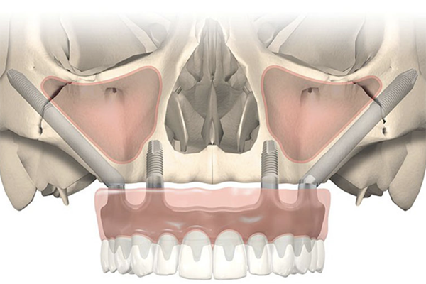 Những điều cần biết về cấy ghép Implant zygoma