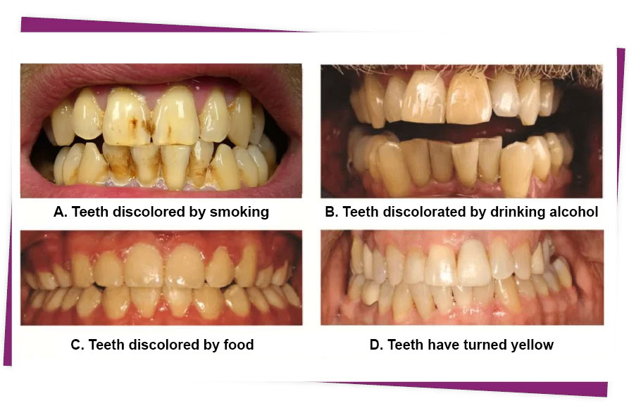 Teeth Whitening CAUSES OF TEETH TURNING YELLOW
