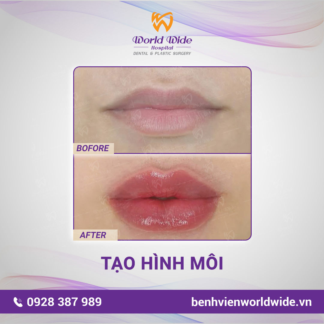 PTTM BF -AT VUONG-môi