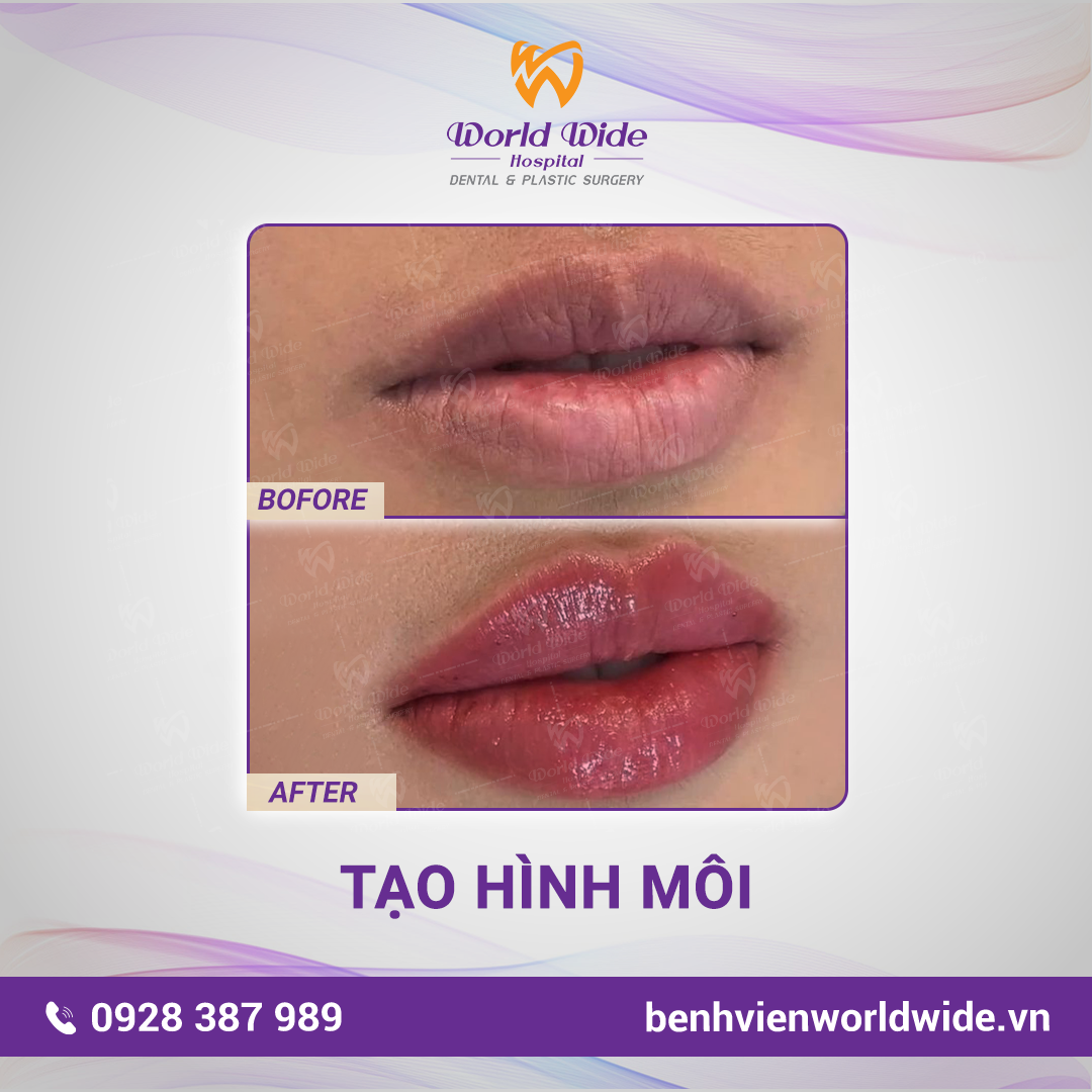 PTTM BF -AT VUONG-môi