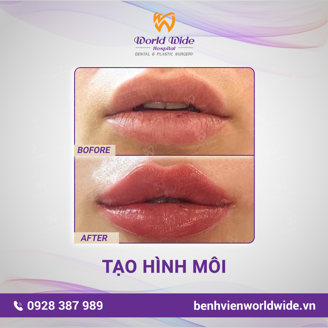 PTTM BF -AT VUONG-môi