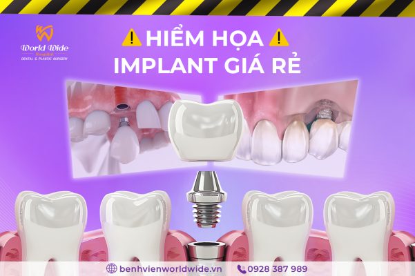 implant