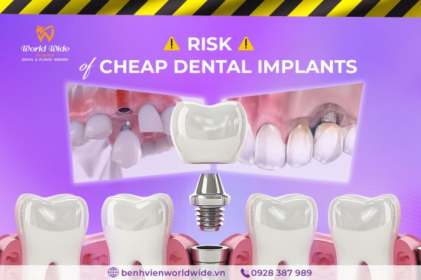cheap dental implant