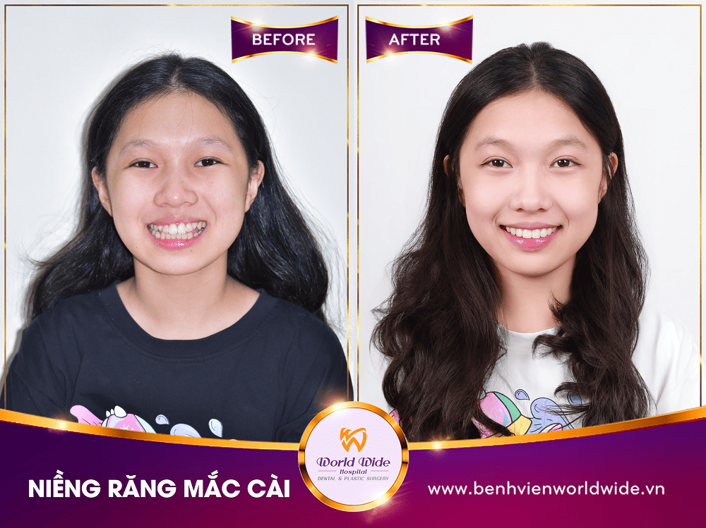 Các loại mắc cài niềng răng nieng rang mac cai