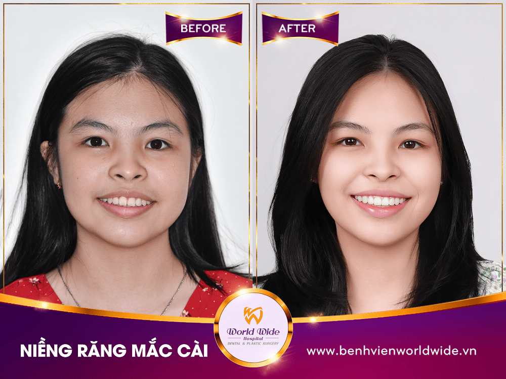 Các loại mắc cài niềng răng nieng rang mac cai