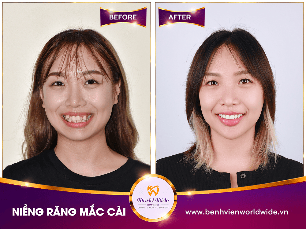 Các loại mắc cài niềng răng nieng rang mac cai