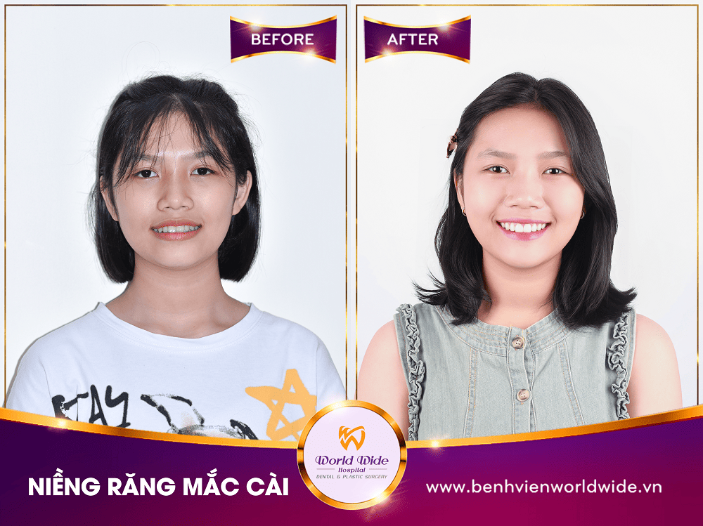 Các loại mắc cài niềng răng nieng rang mac cai