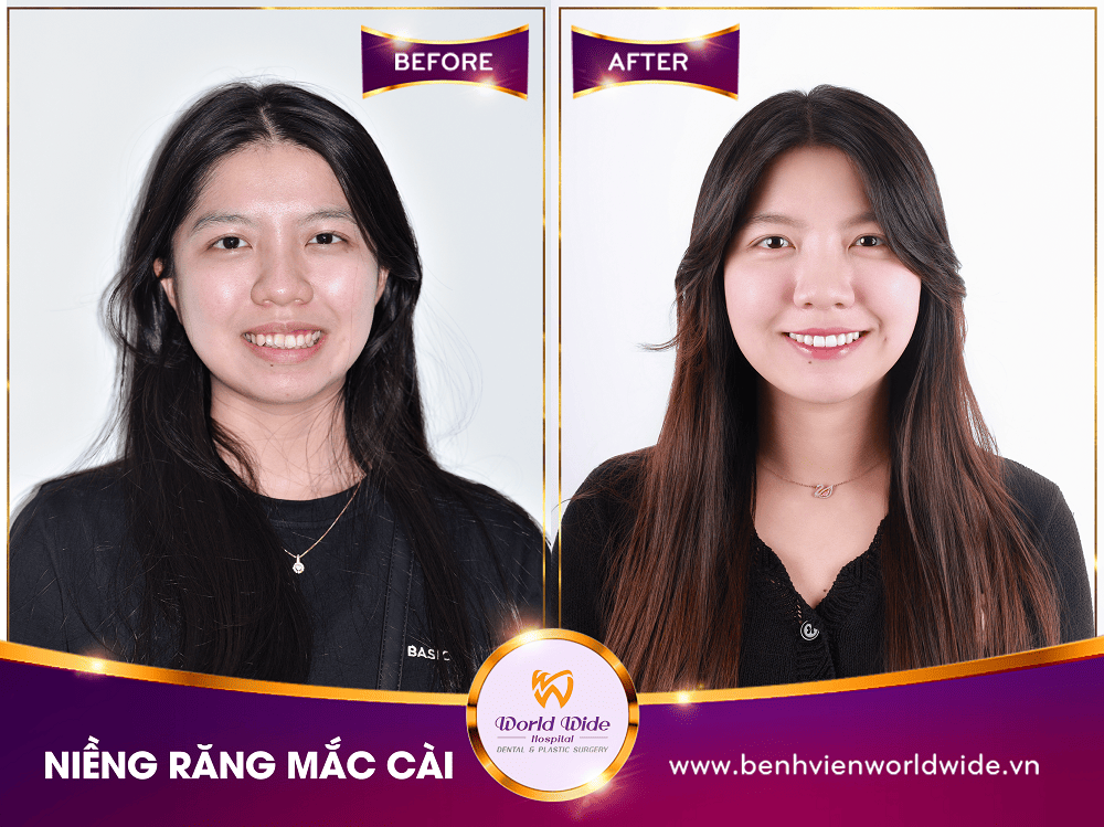 Các loại mắc cài niềng răng nieng rang mac cai