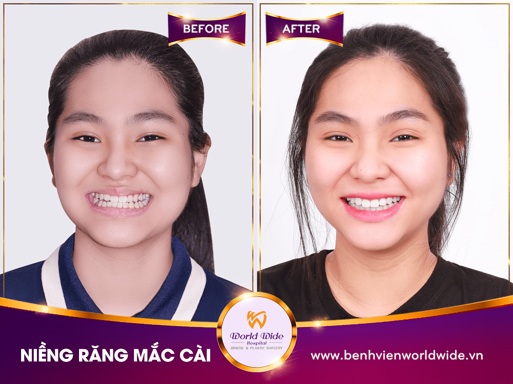 Các loại mắc cài niềng răng nieng rang mac cai