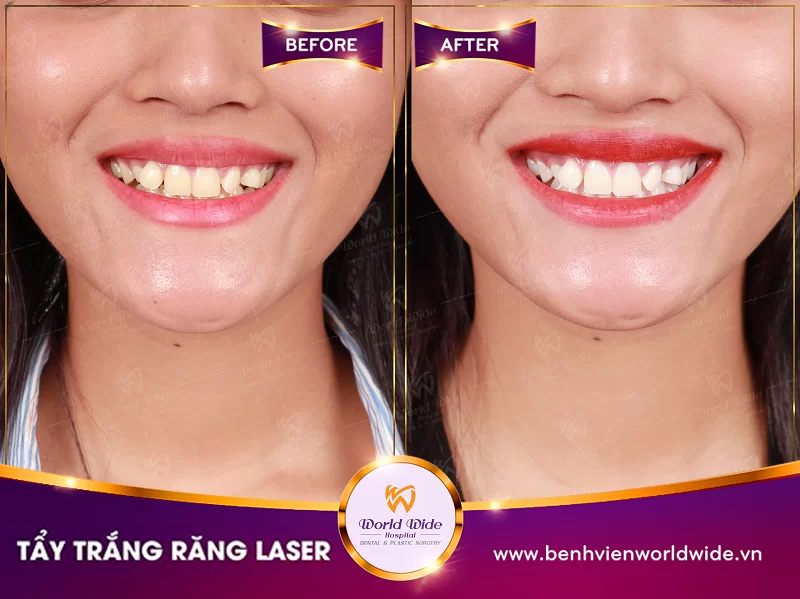Tẩy trắng răng tay-trang-rang-laser