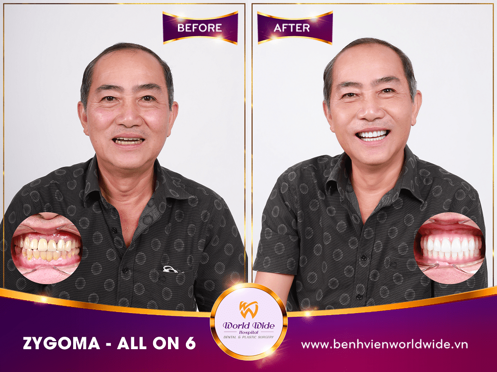 Dịch vụ răng hàm mặt zygoma-all-on-6