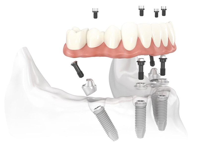 Trồng nhiều răng implant cùng lúc có được không? Giải pháp hiệu quả cho người mất răng toàn hàm
