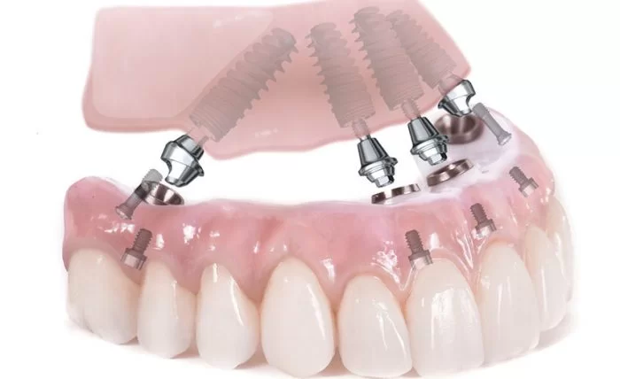 Trồng nhiều răng implant cùng lúc có được không? Giải pháp hiệu quả cho người mất răng toàn hàm