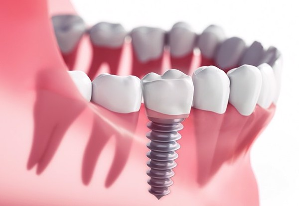 Cấy ghép implant có đau không? Giải pháp không đau tại Bệnh viện RHM Worldwide
