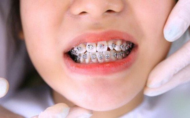 Niềng răng ở trẻ em: Có nên không? Lợi ích và những điều cha mẹ cần biết