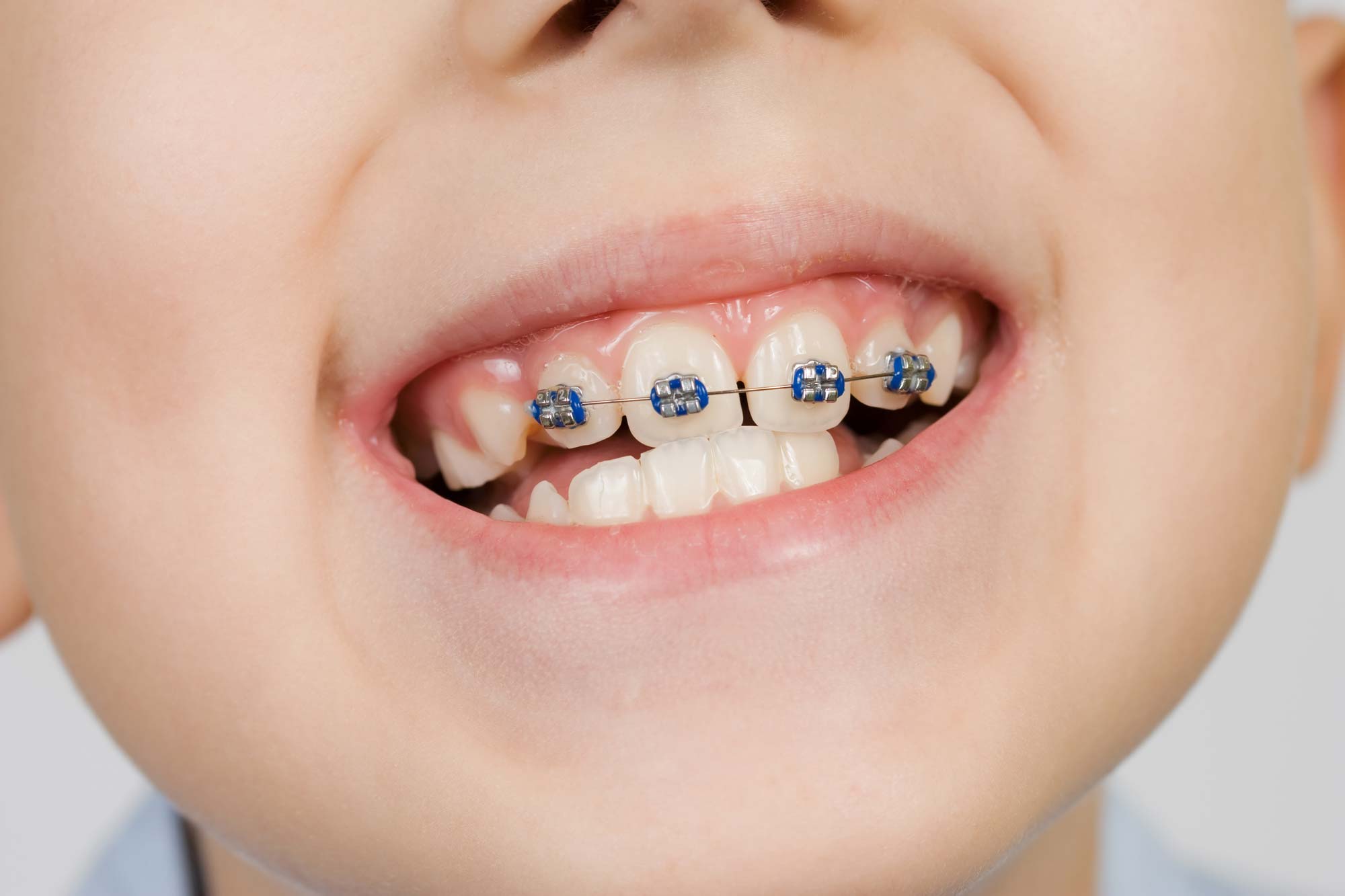 Giá niềng răng cho trẻ em: Chi phí cho từng độ tuổi từ 10 đến 12