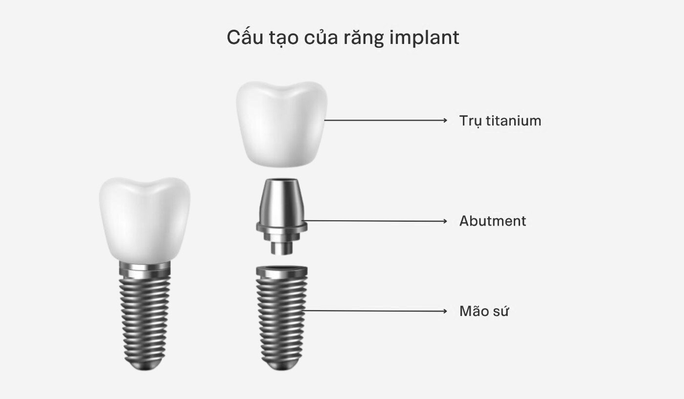 Người lớn tuổi mất răng nhiều: Có nên cấy implant toàn hàm không?
