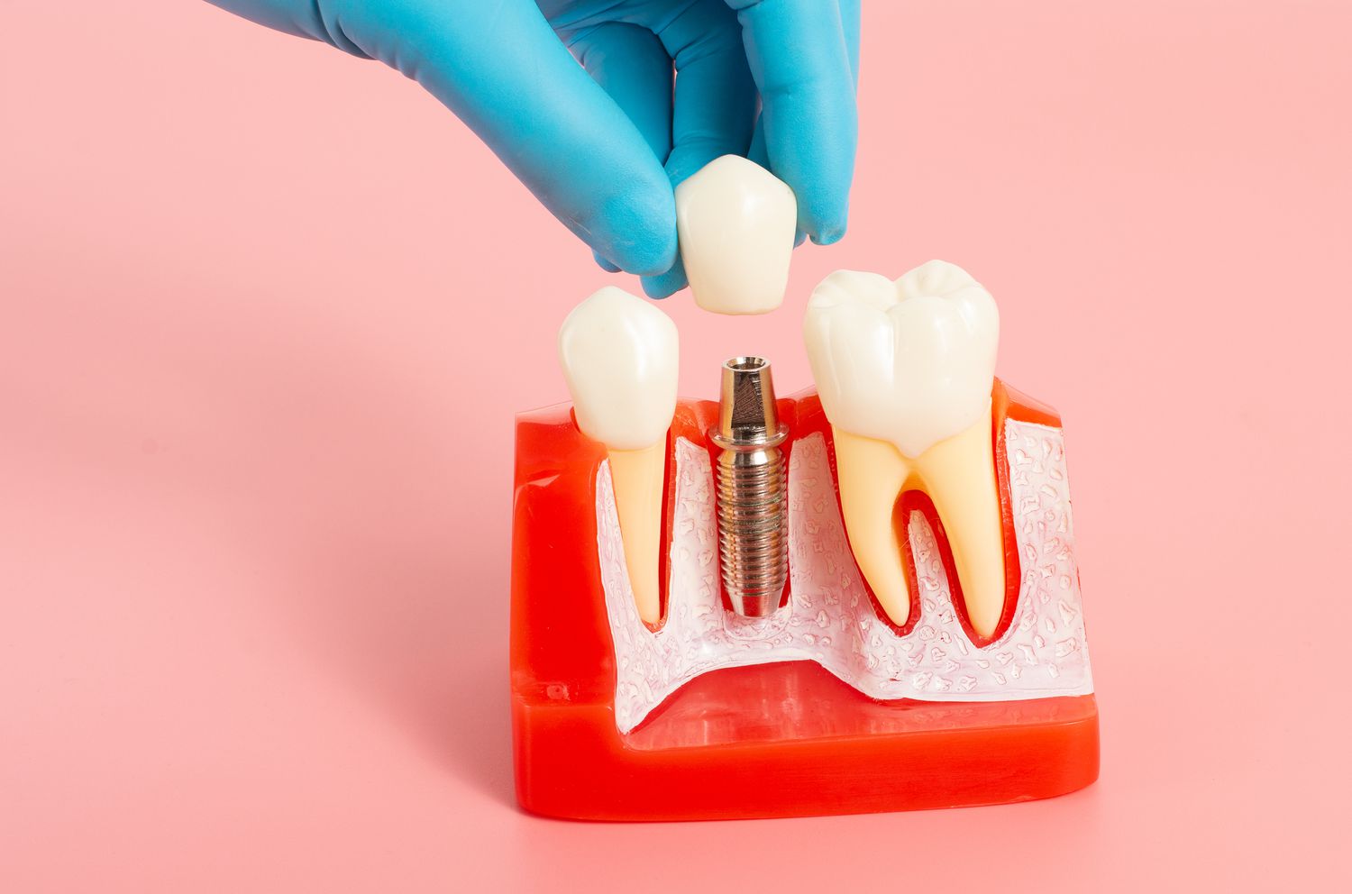 Người lớn tuổi mất răng nhiều: Có nên cấy implant toàn hàm không?
