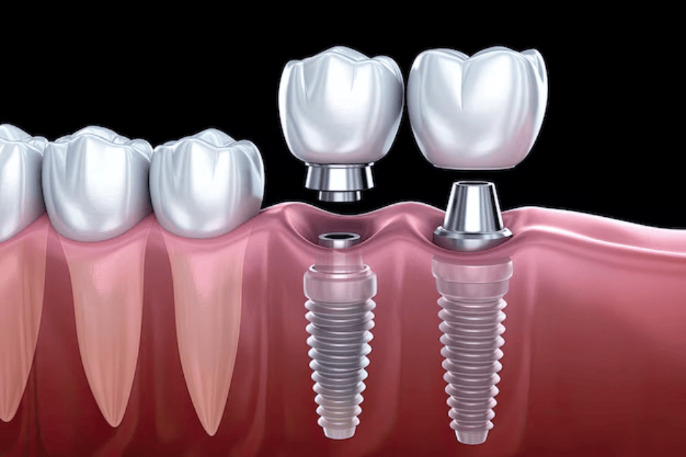 Người lớn tuổi mất răng nhiều: Có nên cấy implant toàn hàm không?
