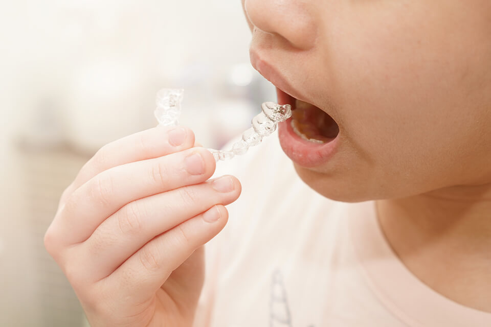 Niềng răng trong suốt cho trẻ em: Giải pháp thẩm mỹ và tiện lợi