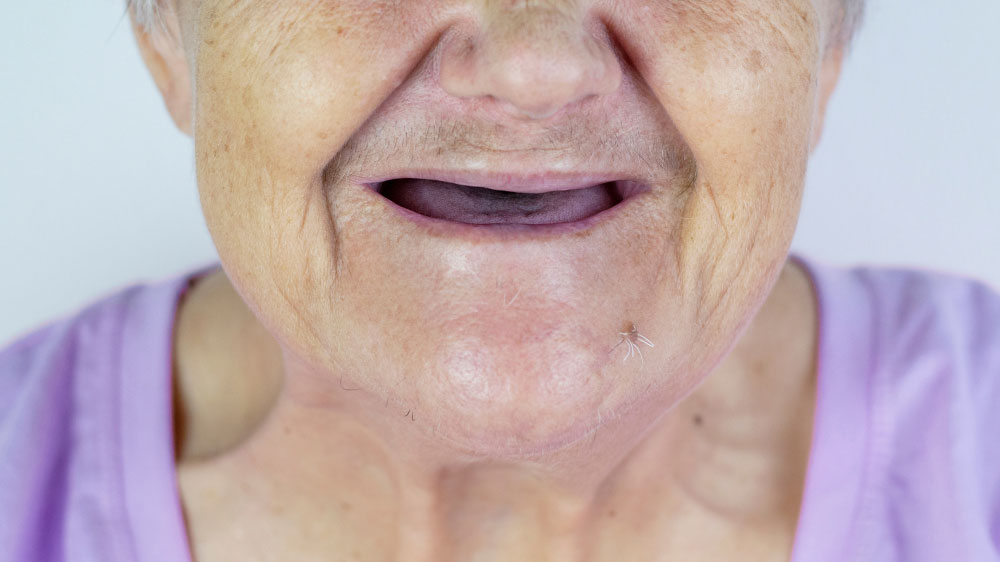 Người lớn tuổi có trồng được implant toàn hàm không?