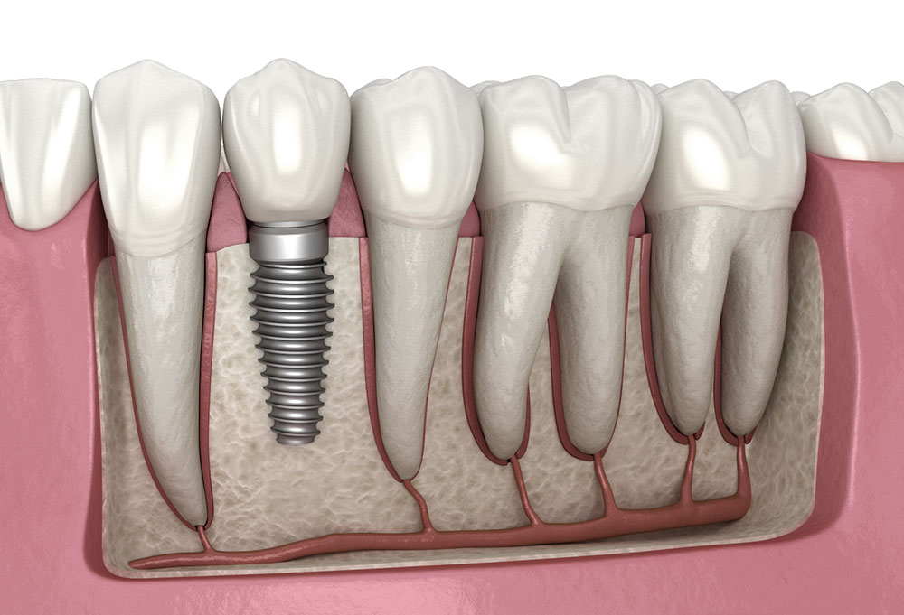 Bảo dưỡng implant định kỳ: Chìa khóa giữ vững độ bền và sức khỏe răng miệng