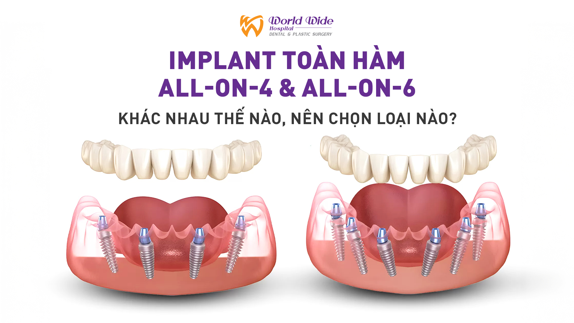 Implant toàn hàm All-on-4, All-on-6: Khác nhau thế nào, nên chọn loại nào?
