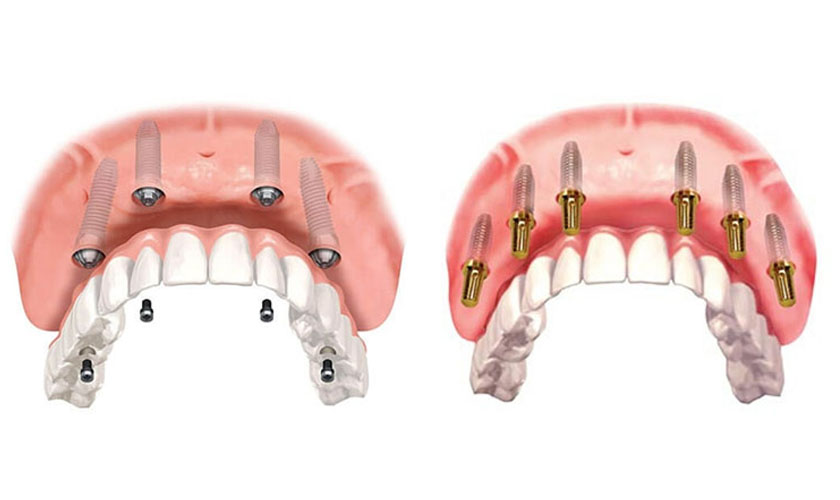 Implant toàn hàm All-on-4, All-on-6: Khác nhau thế nào, nên chọn loại nào?