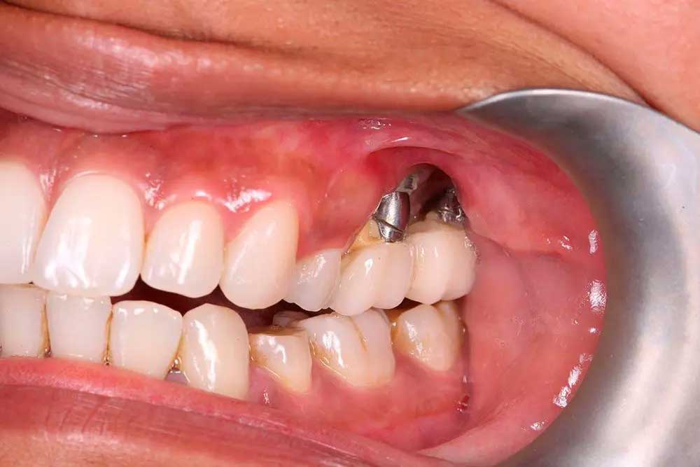 Làm sao để biết implant có đang bị viêm? Dấu hiệu cần đi khám gấp