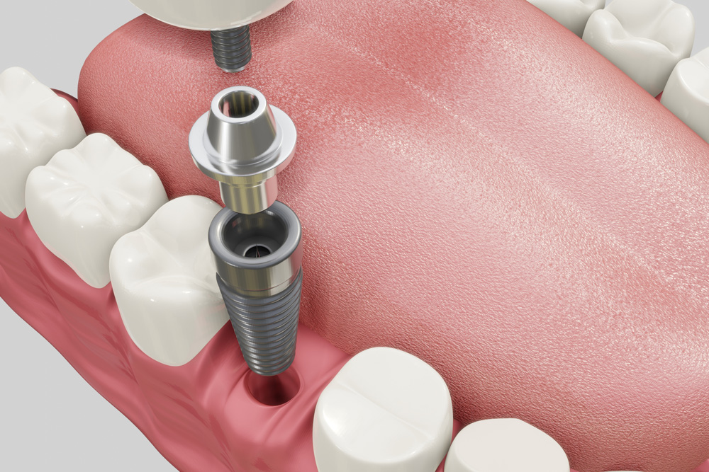 Làm sao để biết implant có đang bị viêm? Dấu hiệu cần đi khám gấp