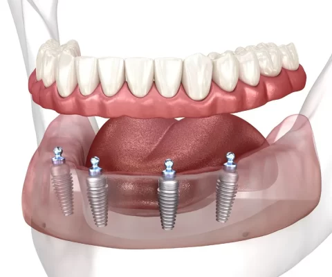 Trồng răng implant All on 4