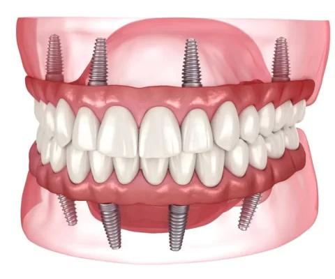 Trồng răng implant cho mất răng toàn hàm như thế nào?
