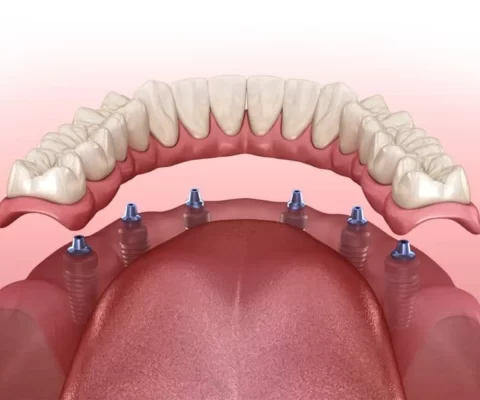 Trồng răng implant All on 6 là gì? Ai có thể thực hiện? Ưu điểm của phương pháp trồng răng implant All on 6