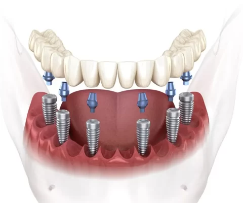 Trồng răng implant All on 6 là gì? Ai có thể thực hiện? Trồng răng implant All on 6
