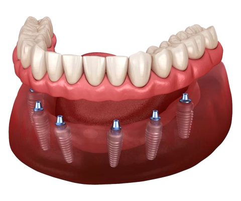 Trồng răng implant toàn hàm All on 6