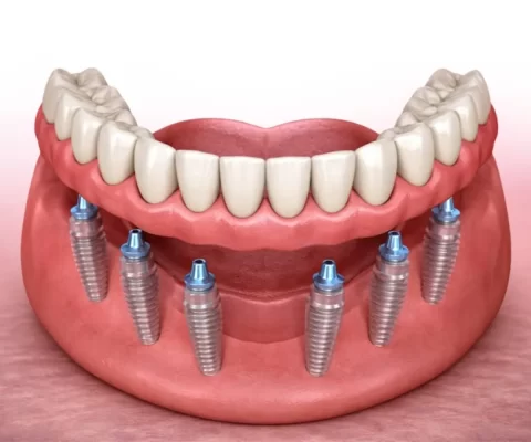 Trồng răng implant All on 6 là gì? Ai có thể thực hiện? Trồng răng implant All On 6 là gì?