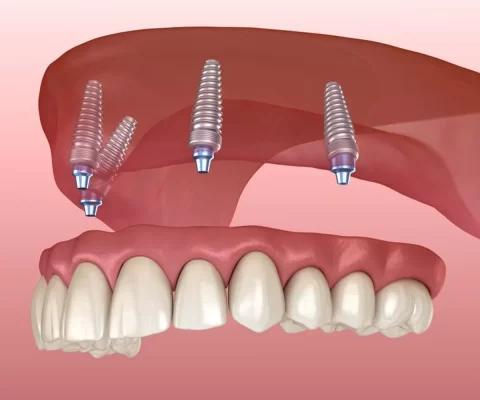 Kỹ thuật trồng răng implant cho mất răng toàn hàm 