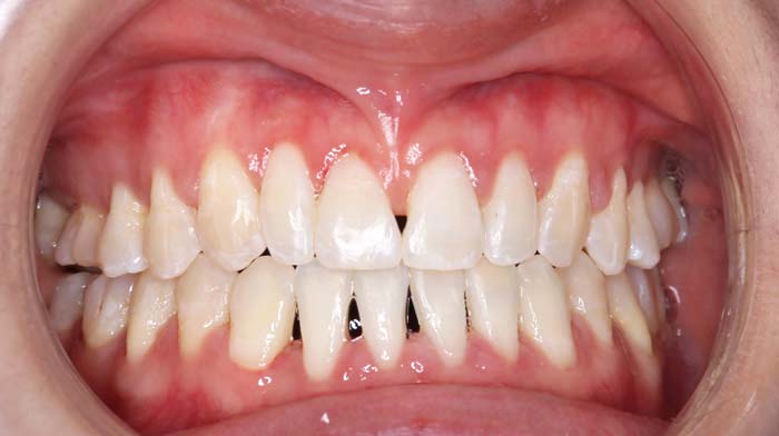 Niềng răng cấp tốc 6 tháng – Lời cảnh báo từ bác sĩ