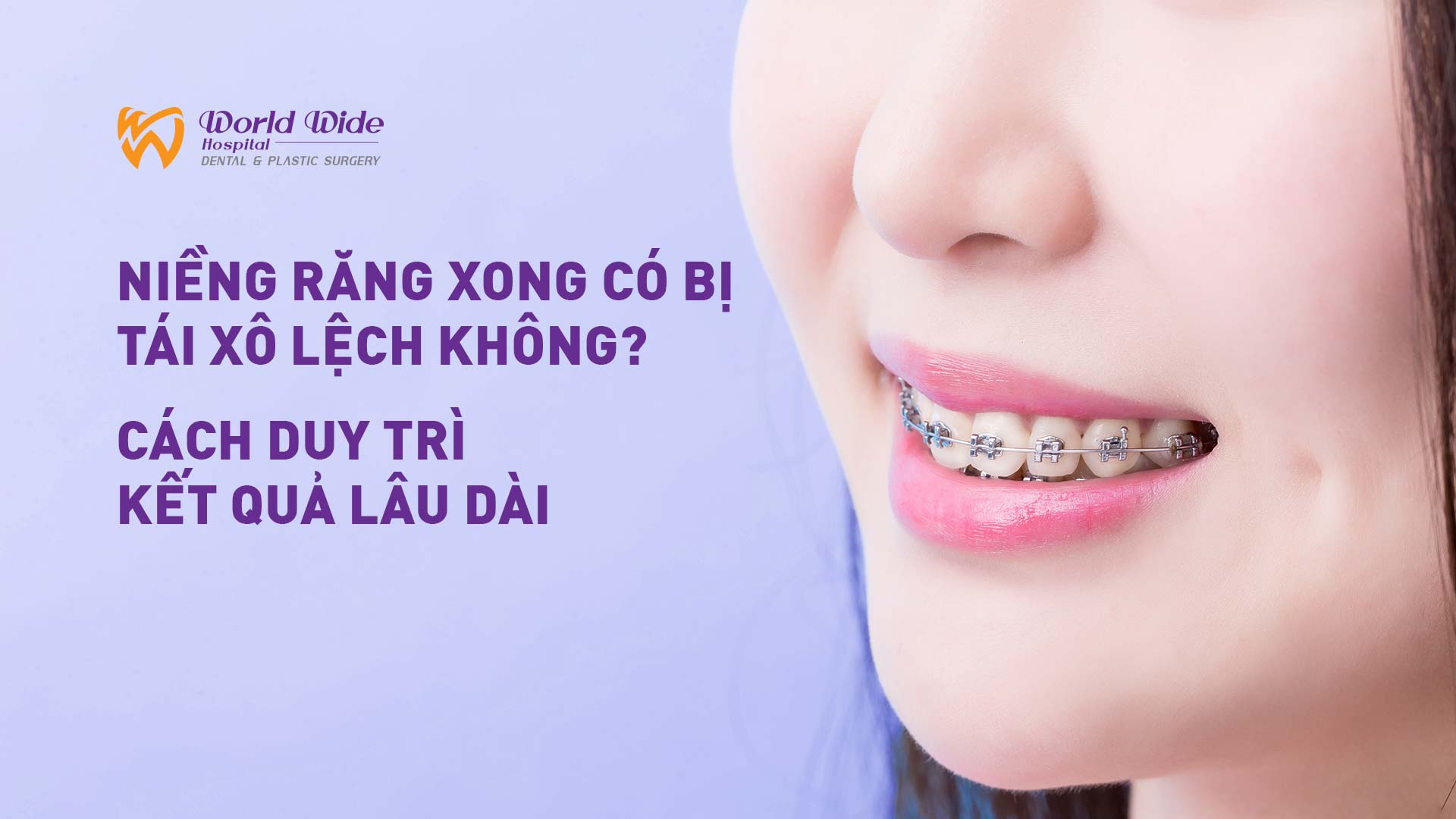Niềng răng xong có bị tái xô lệch không? Cách duy trì kết quả lâu dài