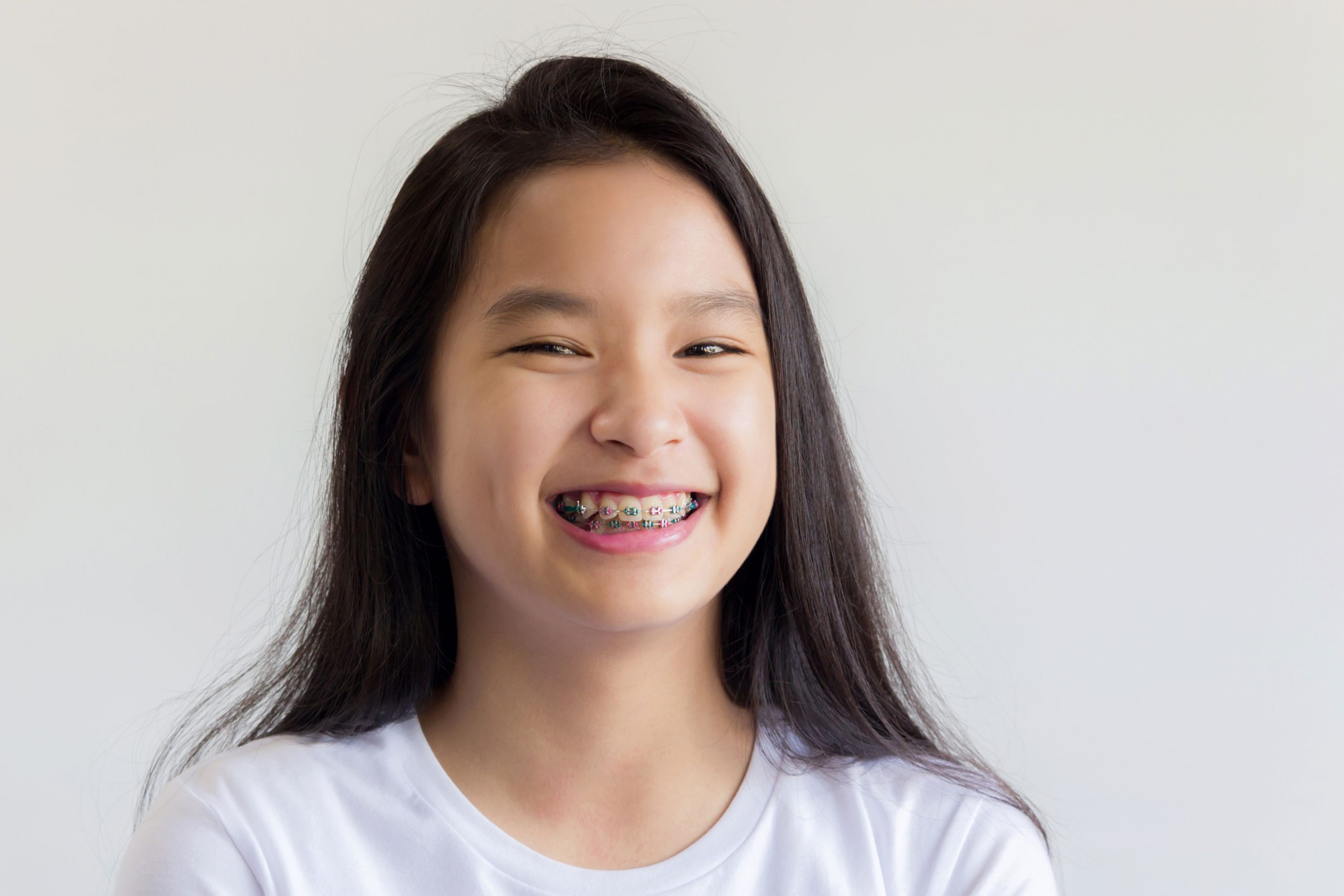 Độ tuổi lý tưởng để niềng răng: Trẻ em, thanh thiếu niên hay người lớn?