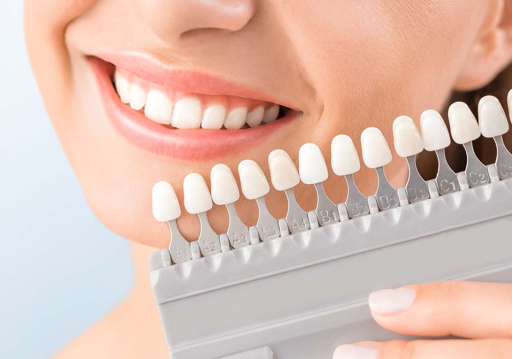RĂNG SỨ HT SMILE: LỰA CHỌN THẨM MỸ CAO CẤP CHO NỤ CƯỜI HOÀN HẢO